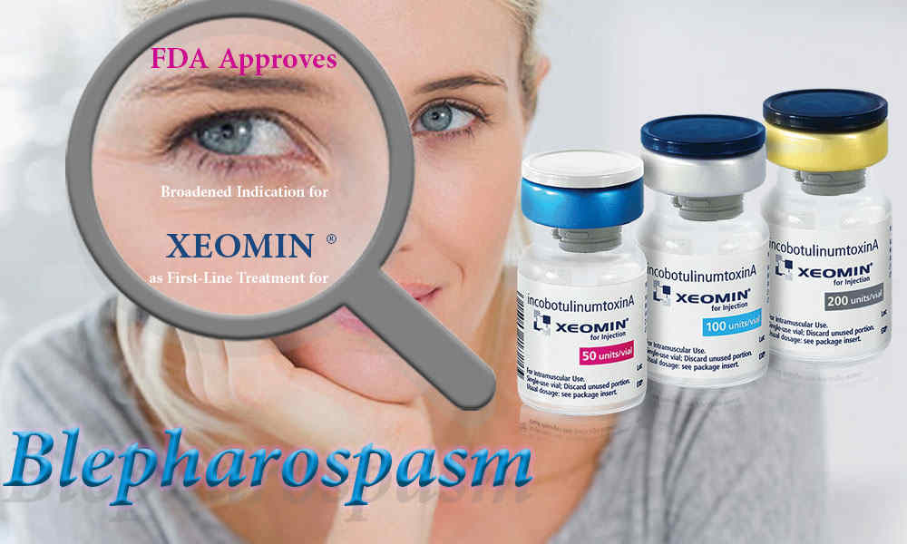 FDA APPROVES BROADENED INDICATION FOR XEOMIN® (INCOBOTULINUMTOXINA) AS FIRST-LINE TREATMENT FOR BLEPHAROSPASM (INVOLUNTARY BLINKING) IN ADULT PATIENTS